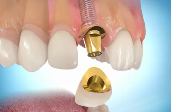 Коронка на зуб или зубные импланты